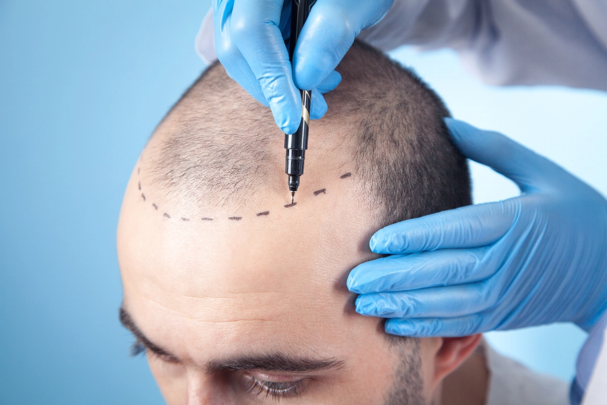 Hair Transplant in Jamnagar: Restoring Confidence with Safety First