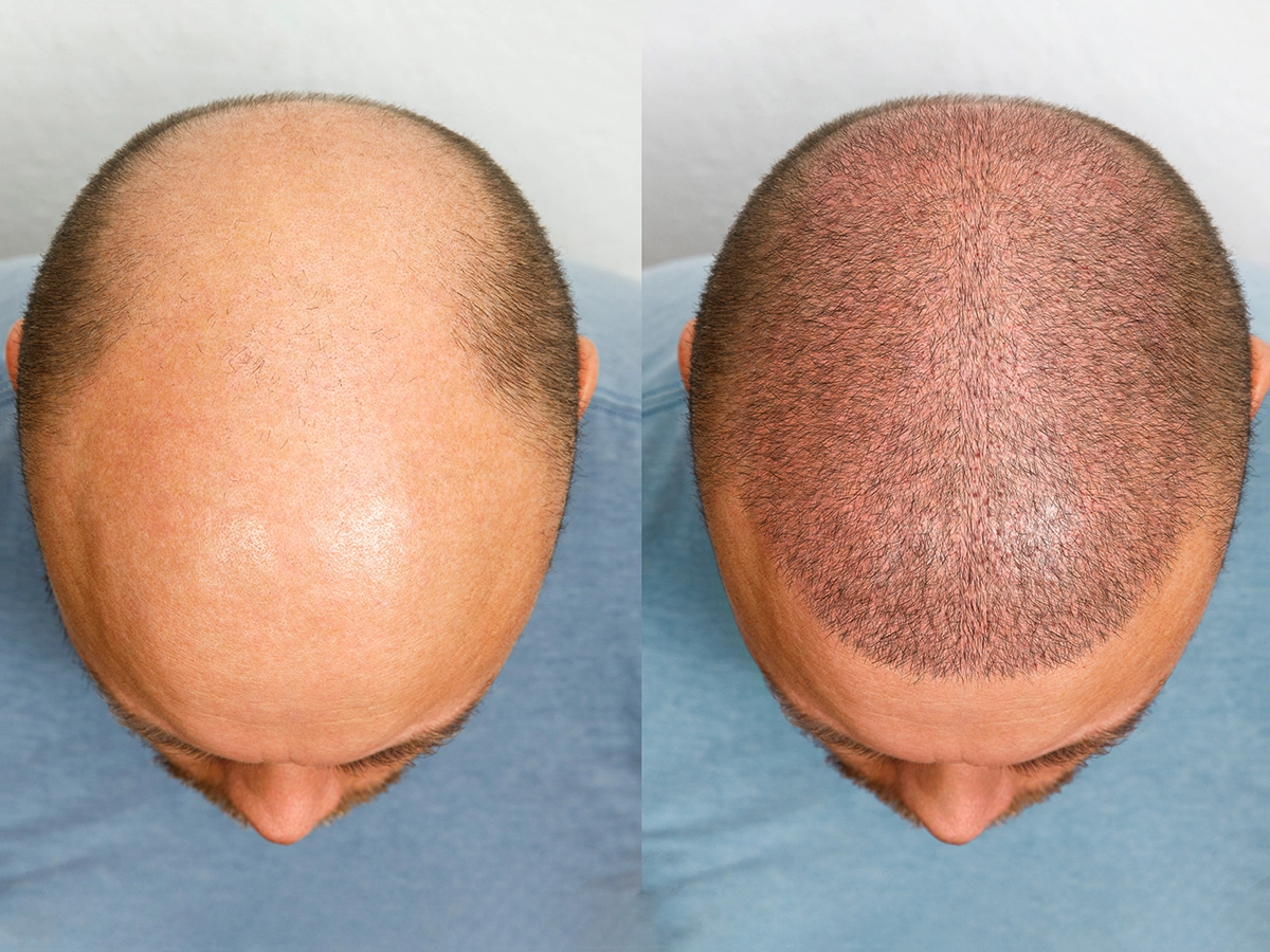 Hair Transplant