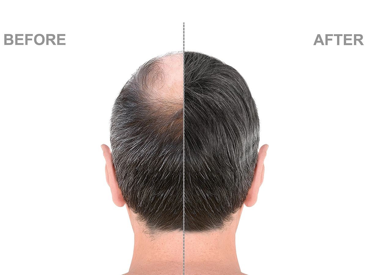 Medical Management of Hair Loss