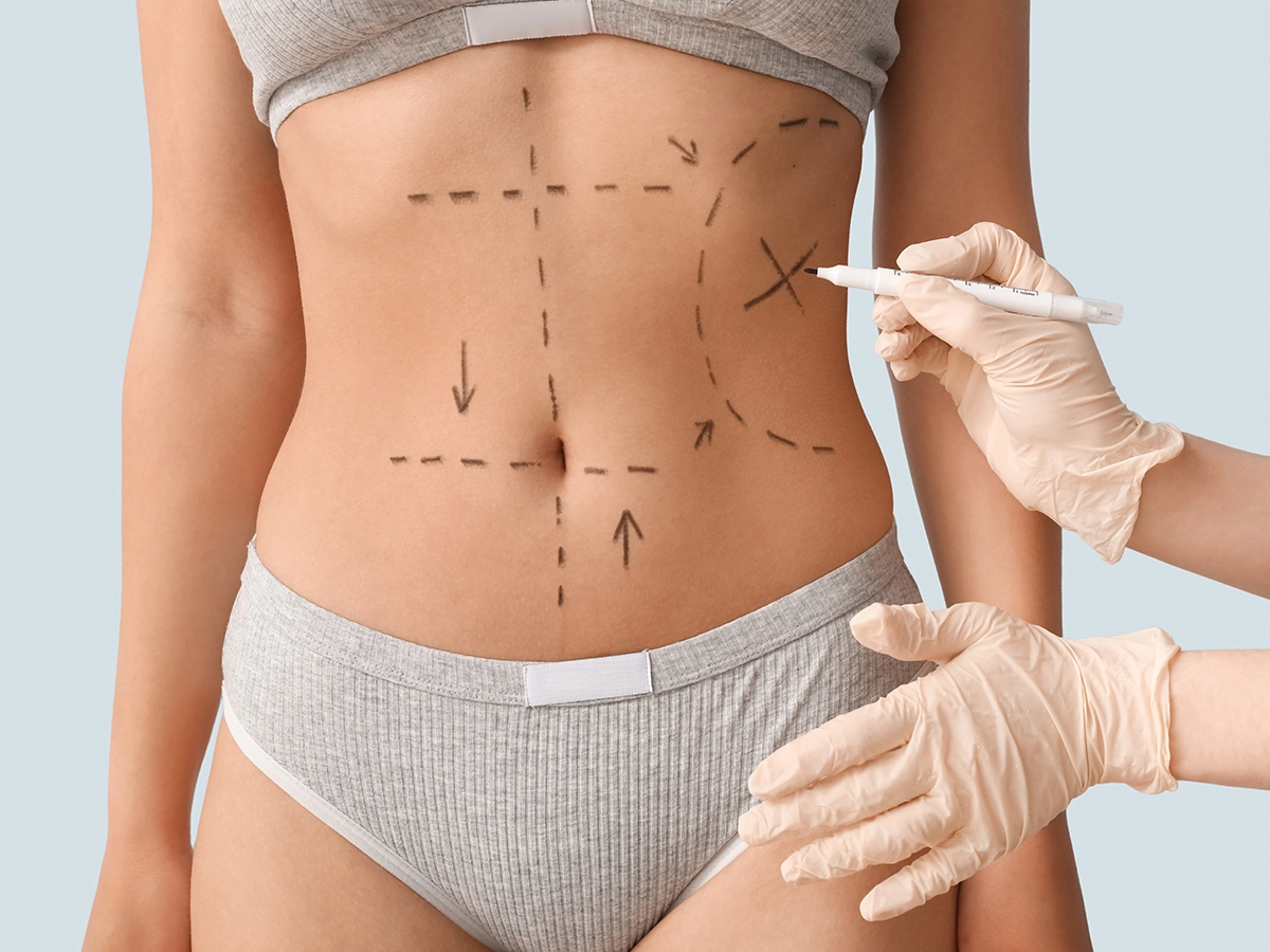 Abdominoplasty (Tummy Tuck)