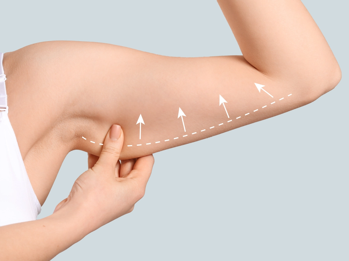 Arm Lift (Brachioplasty)
