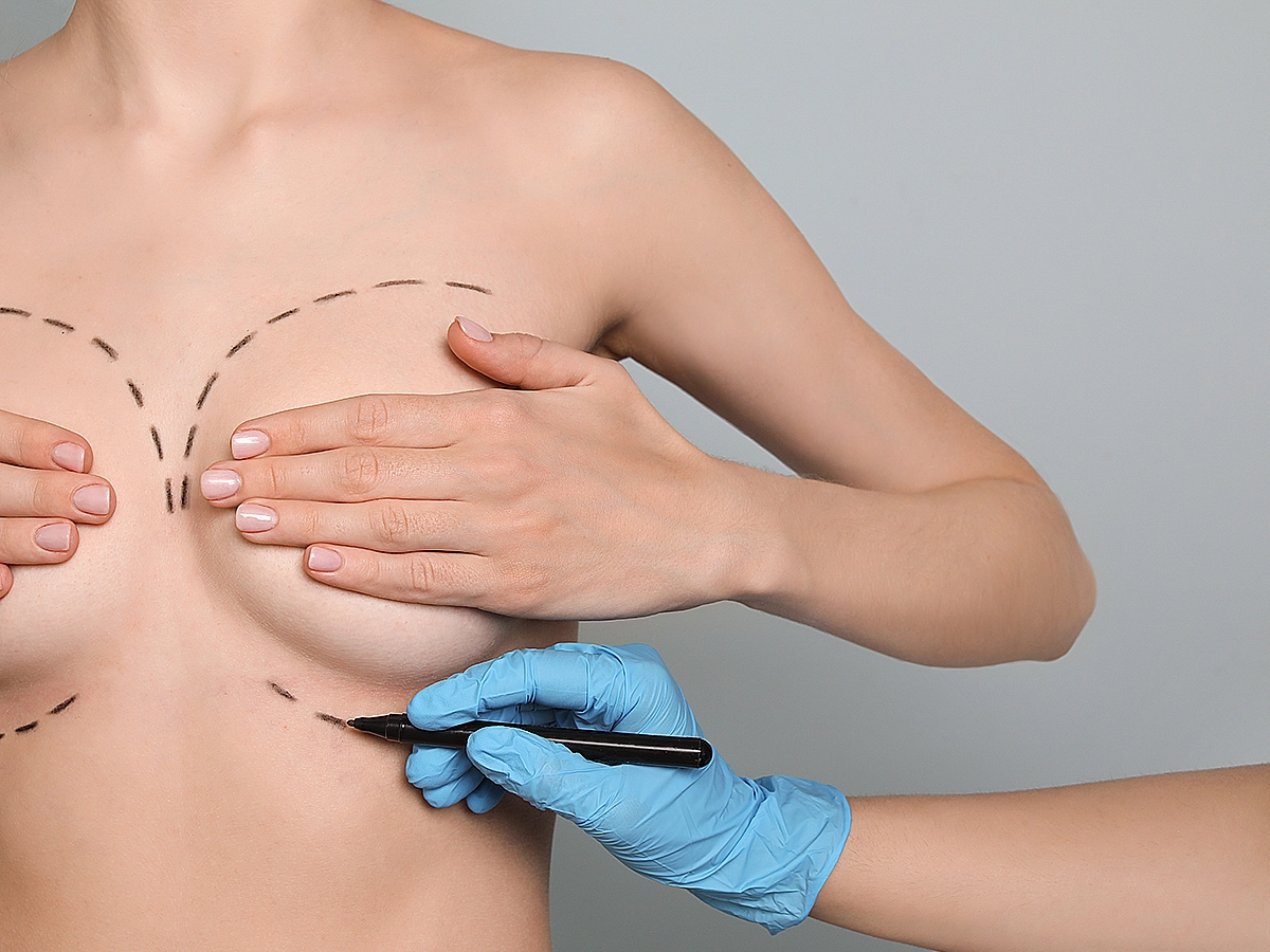 Breast Lift Surgery