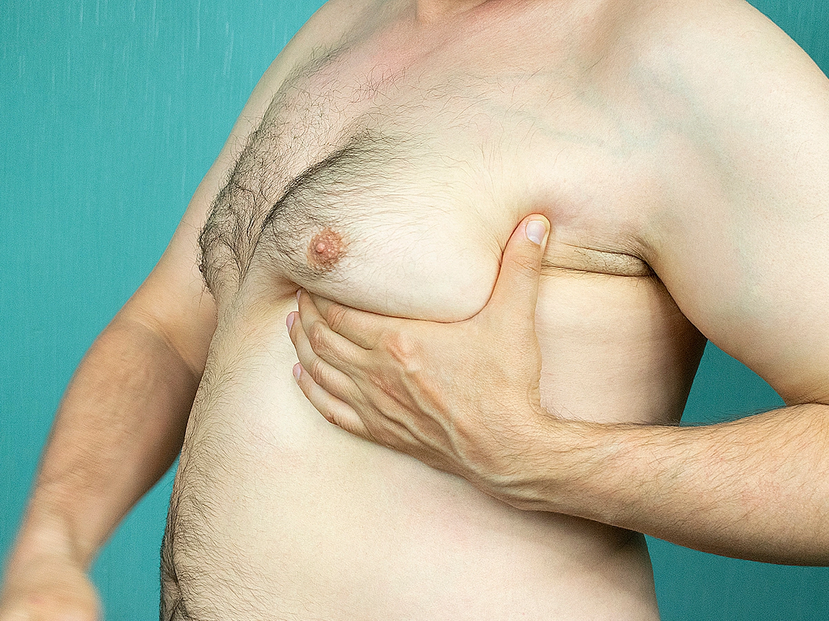Gynecomastia Surgery