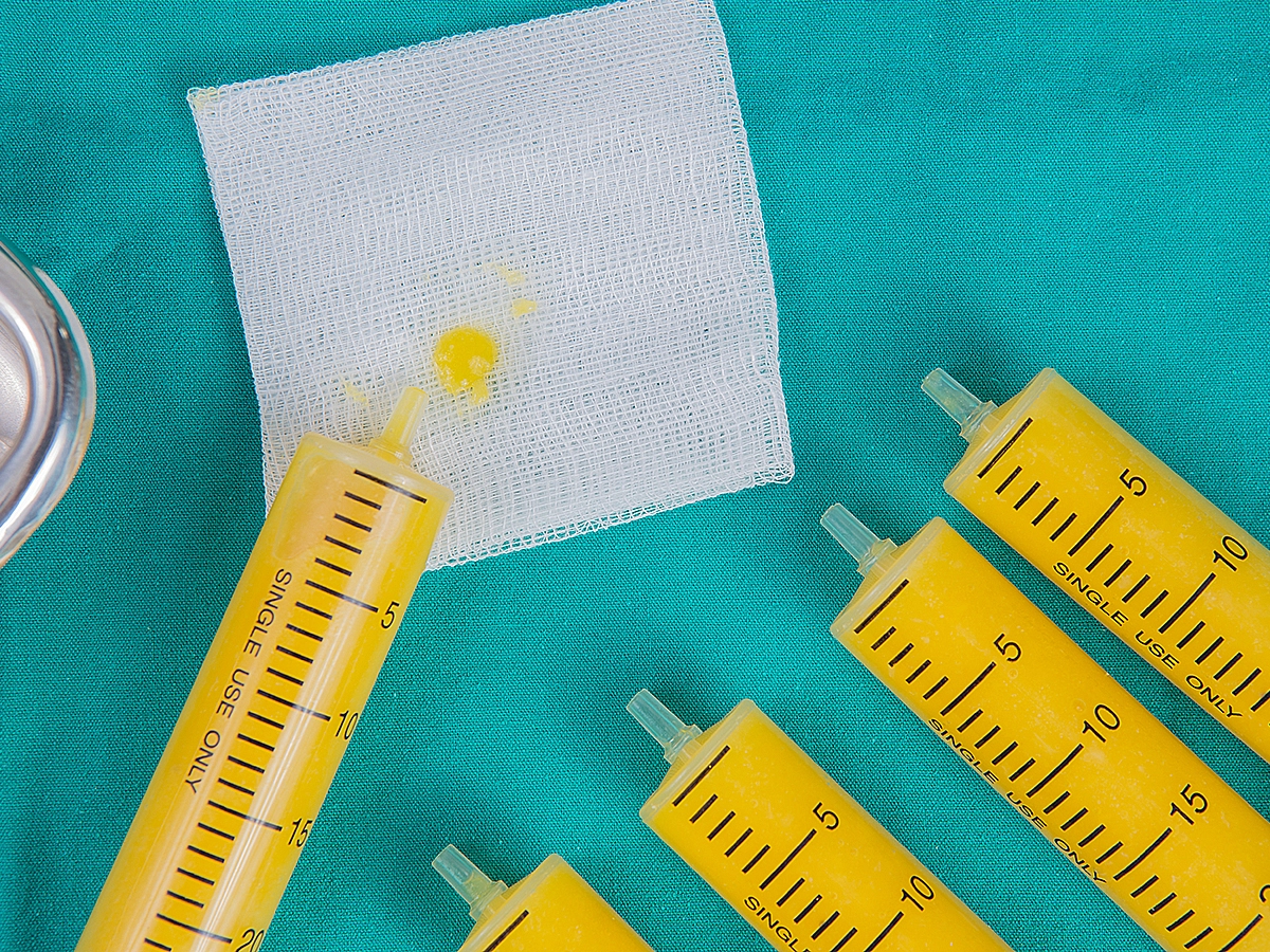 Fat Grafting to the Breast