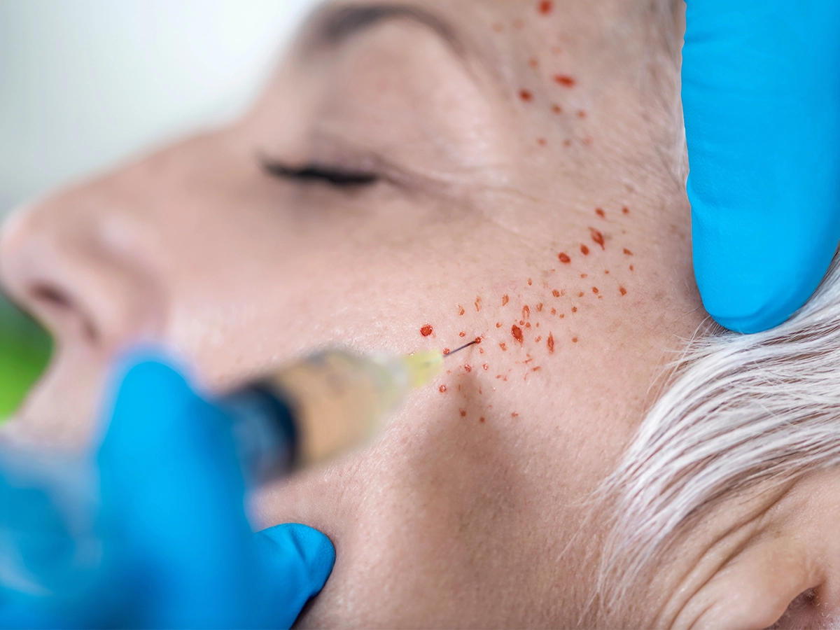 PRP / Vampire Facial