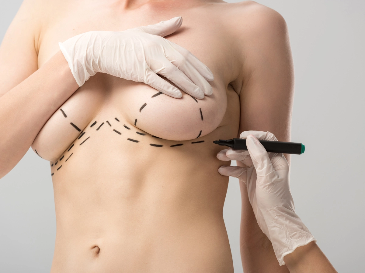 Breast Reduction Surgery